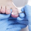 Signs You Need Professional Ingrown Toenail Care