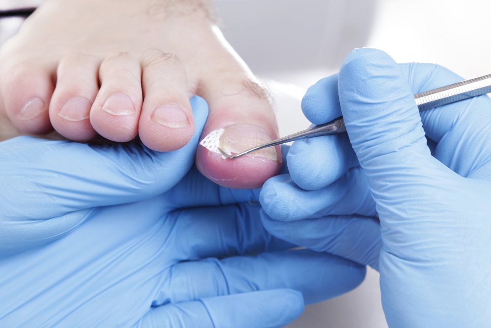 Signs You Need Professional Ingrown Toenail Care