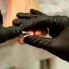 The Benefits of Professional Care for Ingrown Toenails