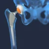 Finding the Right Orthopedic Surgeon for Joint Replacement Surgery