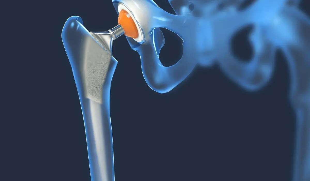 Finding the Right Orthopedic Surgeon for Joint Replacement Surgery