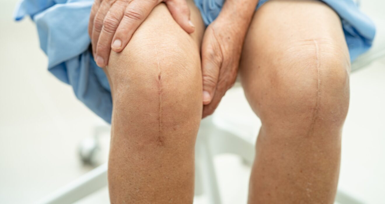 Key Factors in Successful Knee Replacement Outcomes