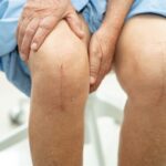 Key Factors in Successful Knee Replacement Outcomes