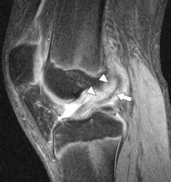 Navigating the Recovery Process After an ACL Tear
