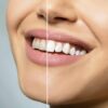 The Role of Teeth Whitening for Special Occasions