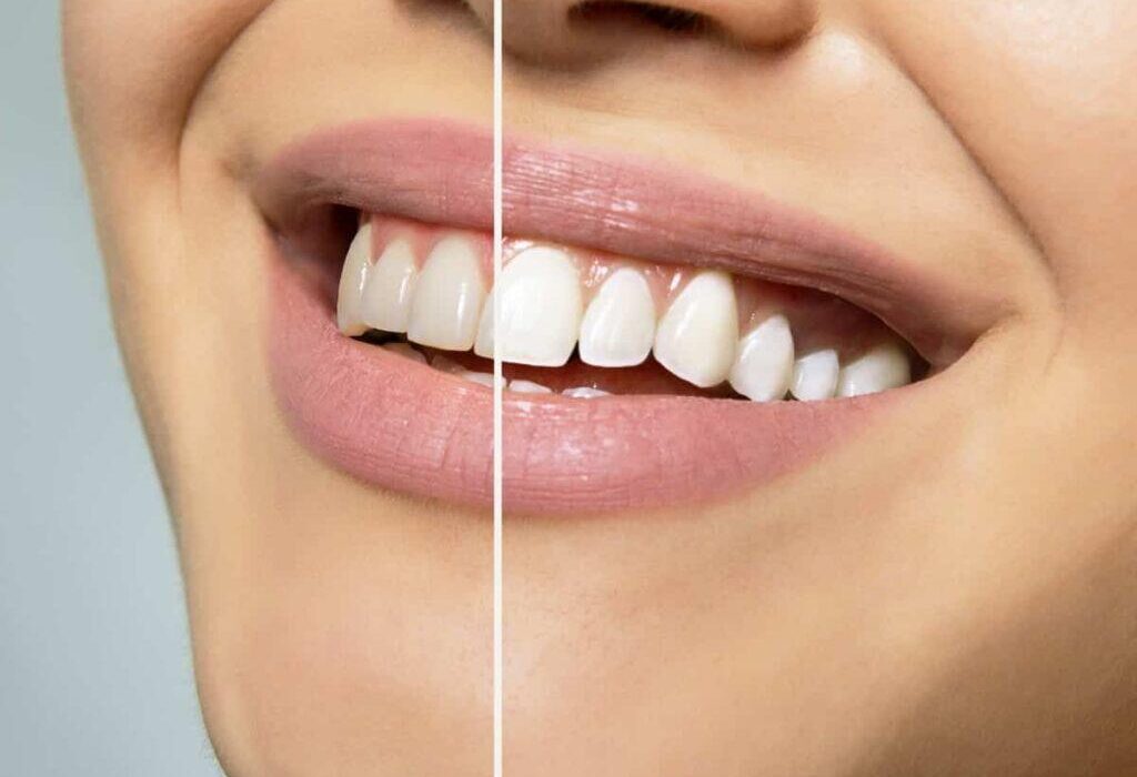 The Role of Teeth Whitening for Special Occasions