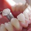 Understanding the Long-term Benefits of Dental Implants